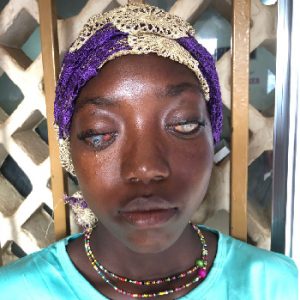 Mujer con deteriorada salud ocular